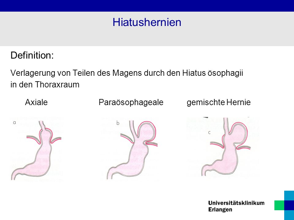 Diät bei Hiatushernie und chronischer Gastritis